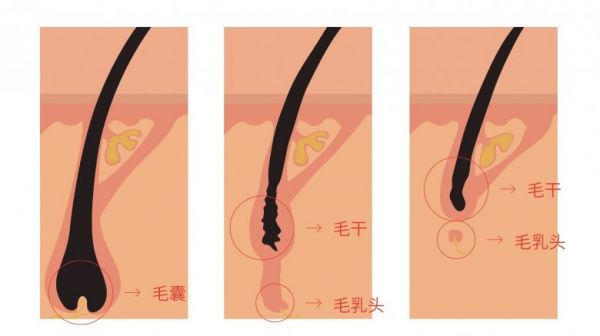 毛囊萎縮過程.jpg